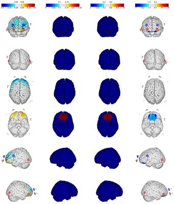 Examining the Dorsolateral and Ventromedial Prefrontal Cortex Involvement in the Self-Attention Network: A Randomized, Sham-Controlled, Parallel Group, Double-Blind, and Multichannel HD-tDCS Study